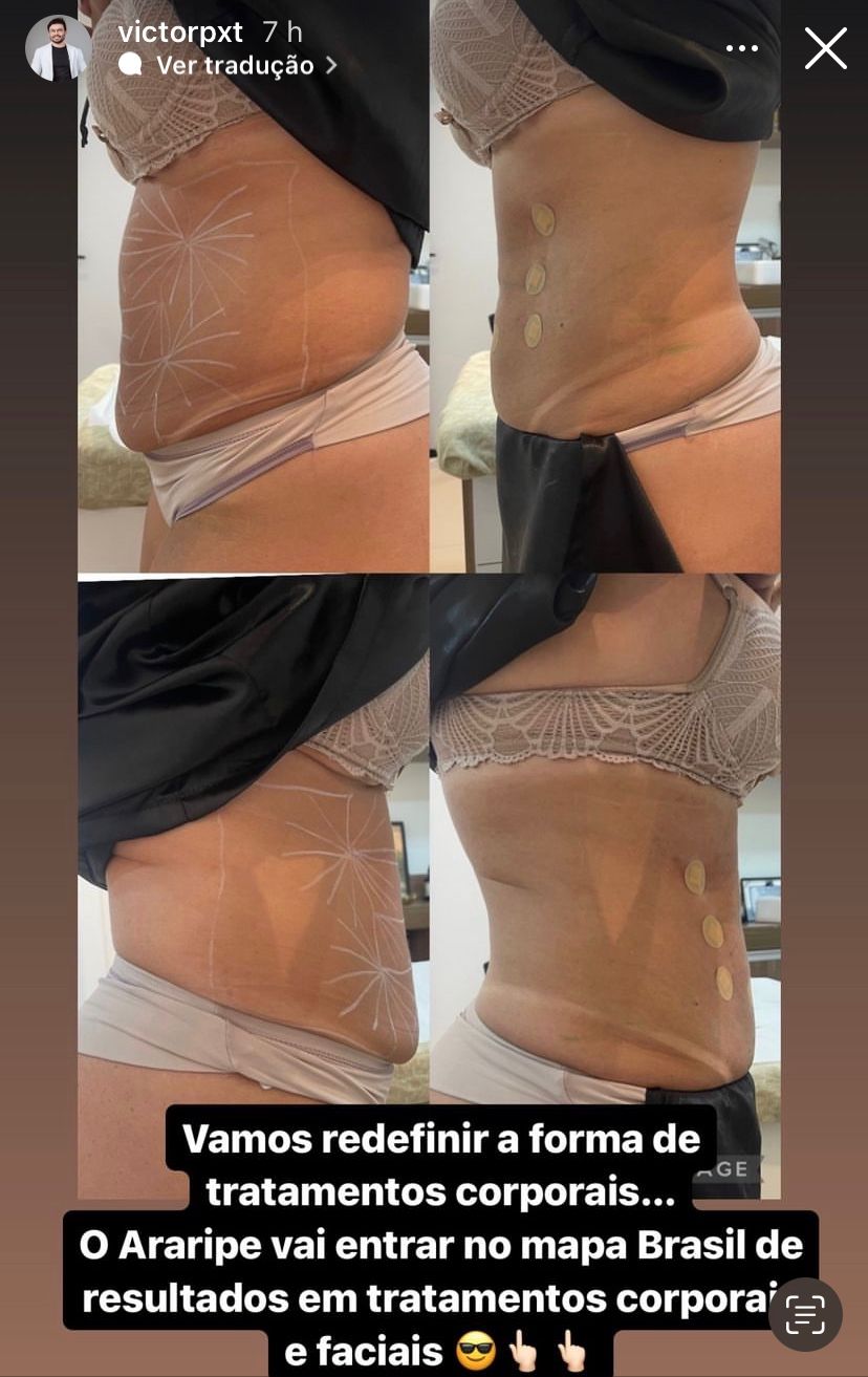 Contorno abdominal lateral
